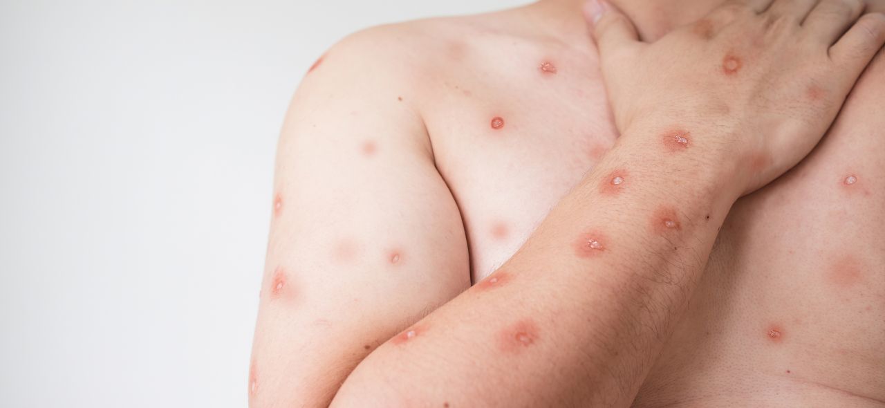 O que é Mpox?